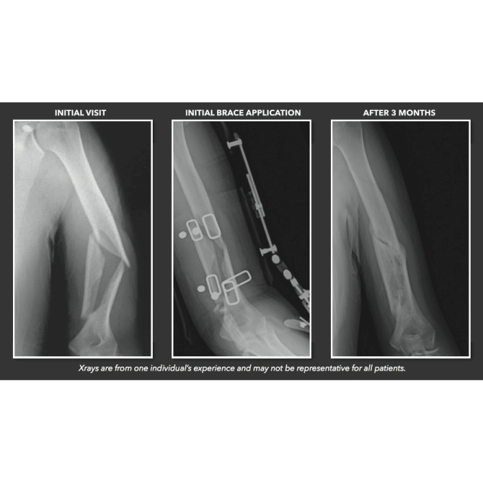 Aligner Phx Humeral Fracture Brace Breg Inc